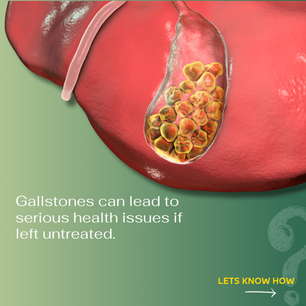 Gallbladder Stone treatment by Innnersciences